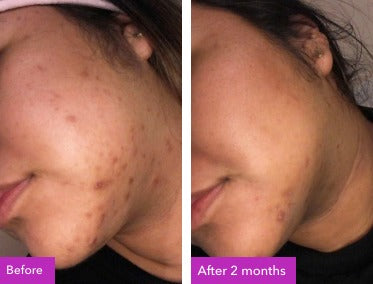 Before and after skincare result